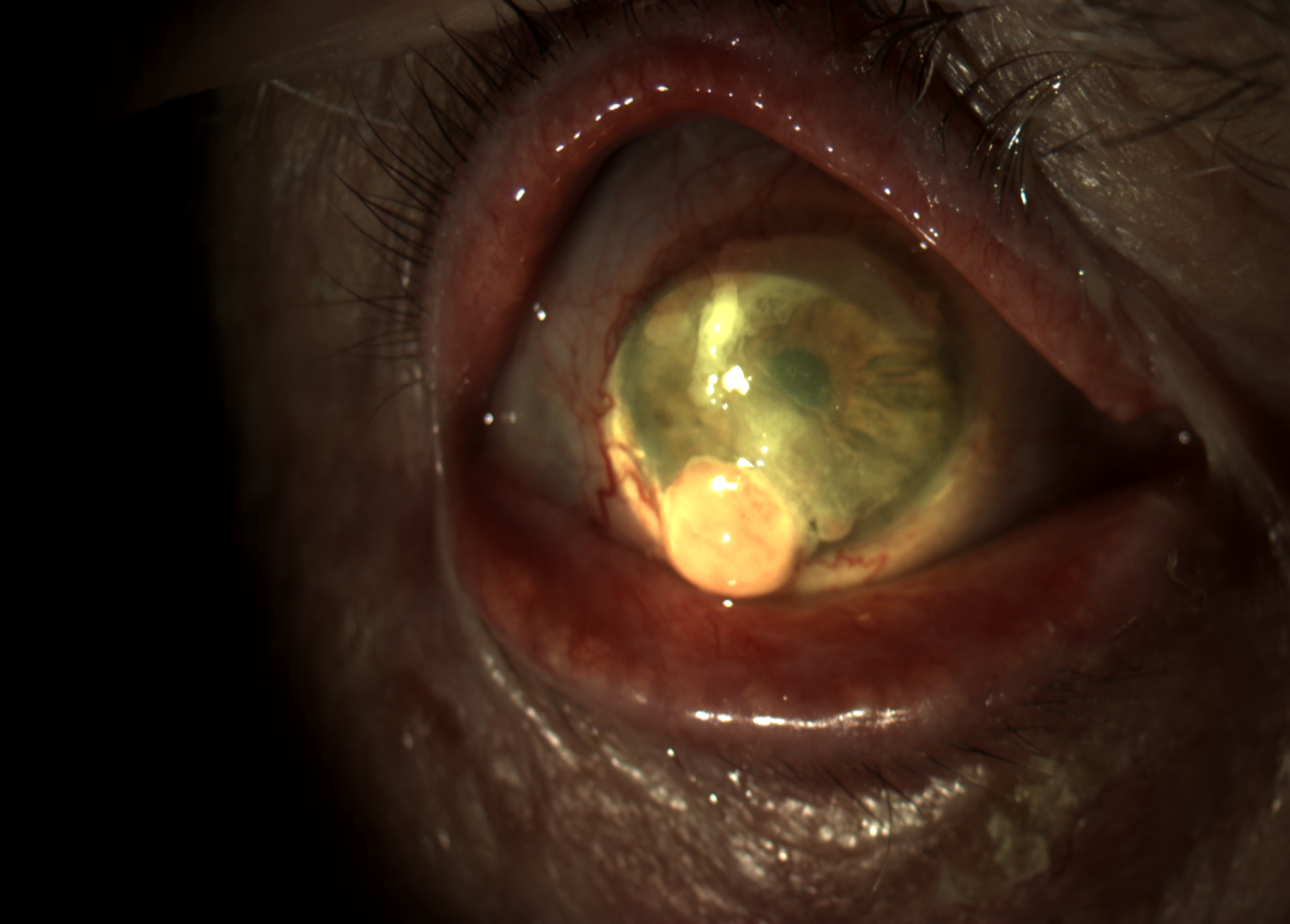 Neoplasia della congintiva conjunctival intraepithelial neoplasia (CIN)